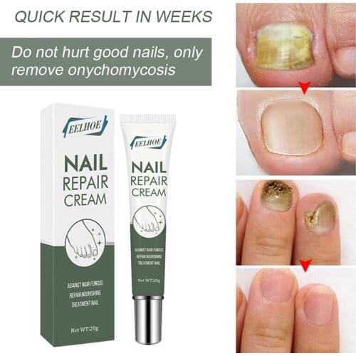 20g Nail Antibacterial Cream Thicken Nails Inhibit Fungus Onychomycosis Care Foot Care Nail Treatments