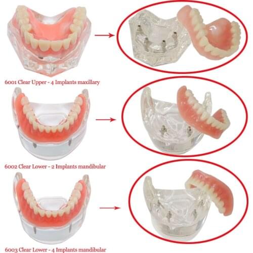 1 pcs dental Implant Teeth Model Overdenture Restoration Clear 6001 Upper 6003 Lower 6002 Lower Implantsmaxillary /mandibular