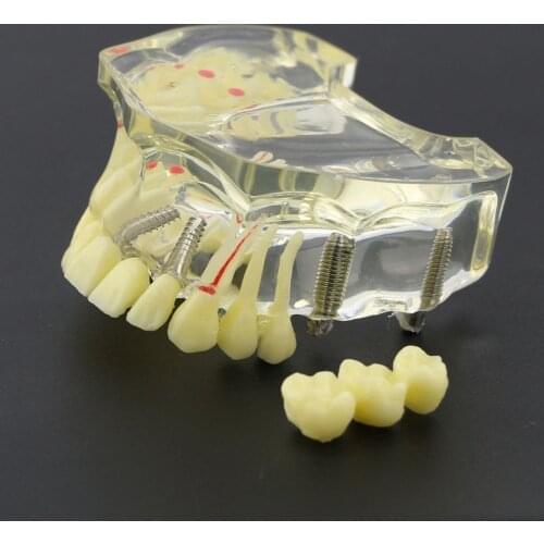 Dental Study Teach Teeth Model Dental Implant Upper Jaw Model With Bridge & Caries