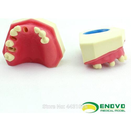 ENOVO The dental implant was sutured in the oral cavity of maxillary sinus dentition