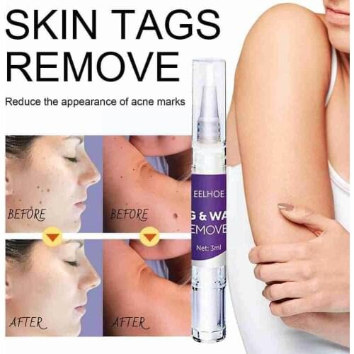Genital Wart Treatment Papillomas Removal of Warts Verruca Liquid Moles Tags Remover Anti Against from Removing Skin Remedy G4U4