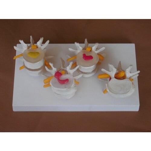 45cm Human lumbar spine model intervertebral disc model lumbar vertebrae bone lesion model 4 pcs