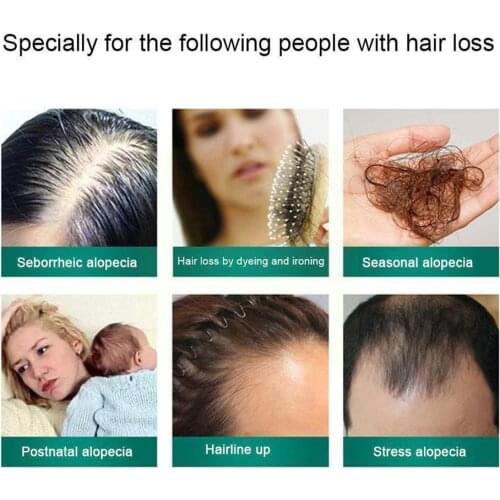 Hair Growth Essence Spray Set Anti Hair Loss Germinal Roots Nourish Hair Biotin Growth Lotion Hair Serum Care Hair Anti-dro B9p8