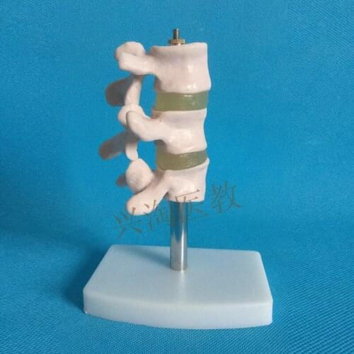 Typical Spine lesion model skeleton model spinal pathological anatomical model