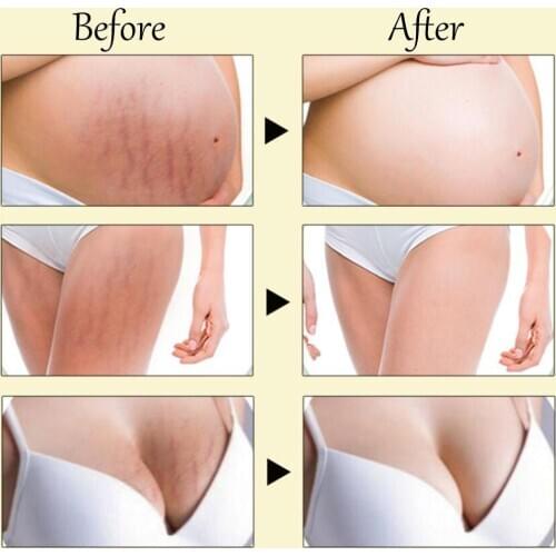 30ml peach kernel Stretch Marks Remover Cream Anti Treatment Eliminate Scars Pregnancy Repair Firming Winkle Skin Maternity R8P0