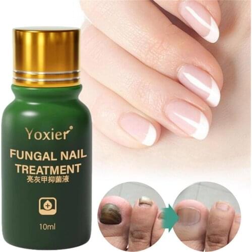 10ml Fungal Nail Treatment Antibacterial Serum Repair Rough Discolored Anti Infection Paronychia Onychomycosis Foot Care