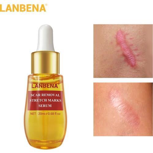 LANBENA Remover Stretch Marks Acne Scar Remove Serum Acne Treatment Anti Acne Shrink Pores Repair Pores Pockmark Cream Skin Care