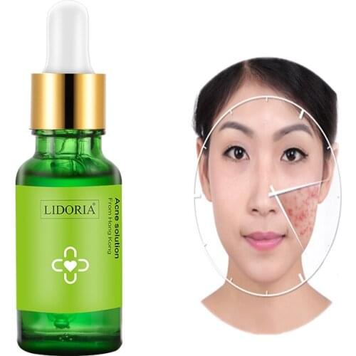 Acne Treatment Face Cream Anti Acne Scar Removal Pimple Blackhead Moisturizing Whiten Oil-control Shrink Pores Essence Skin Care