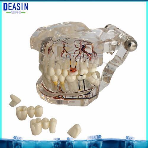 2PCS Dental implant teeth model with nerve pathological Repair Teaching model