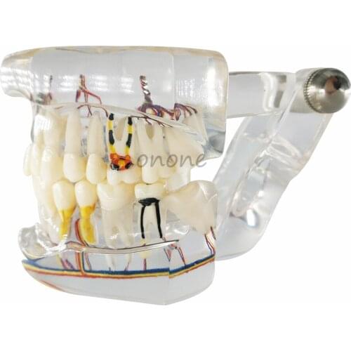 High Quality Dental Teeth Model Transparent Pathological Implant Nerve Model Repair Model Teaching Demonstration model