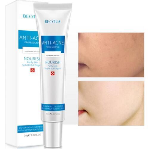 25g Acne Beauty Cream Acne Treatment Blackhead Remova Anti Acne Cream Oil Control Face Care Whitening m1