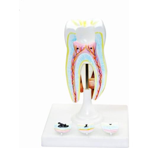 Molar Tooth with Tooth Decay Models Human Lifelike Dental Anatomy Models Biomedical Demonstration Aids Medical Model Supplier