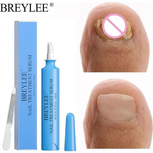 New Nail Fungal Nail Repair Essence Serum Treatment Care Foot Nail Fungus Removal Gel Anti Infection Paronychia Onychomycosis