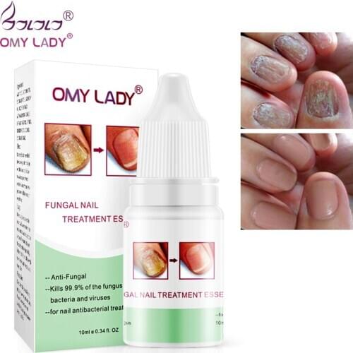 OMY LADY High Quality Nail Protector Skin Care ESSENCE Cream Nail Fungus Treatment Nails Repairing Cream Nail Care Tools 10ml