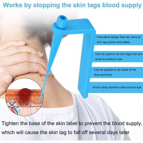 Newest Skin Tag Kill Skin Mole Wart Remover Micro Band Skin Tag Removal Kit With Cleansing Swabs Adult Mole Wart Face Care Tool