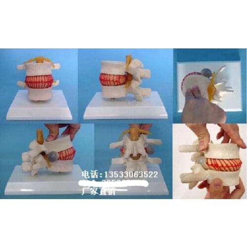 Vertebra Under pressure Demo model spine Skeleton model free shipping