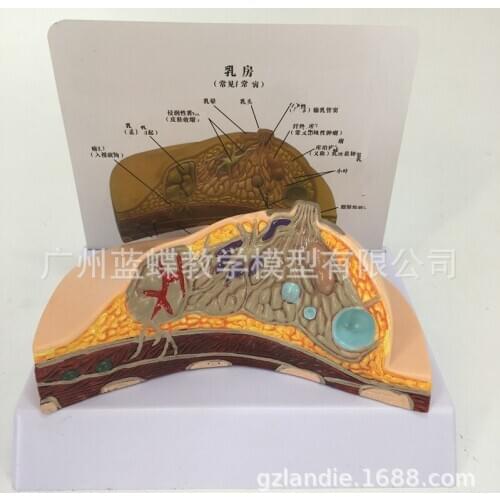 Medical Disease Cancer Breast Anatomy Model Human Body Model Anatomical Pathological Breast Model