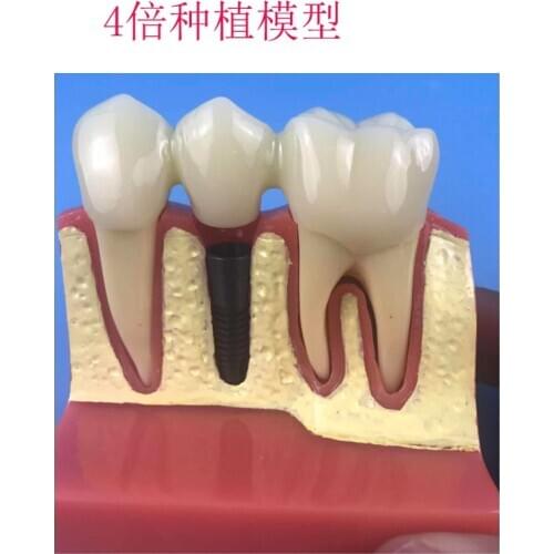 4X Times Oral Tooth Model Human Tooth Anatomical Model Medical Teaching Supplies Dentist Teaching Aids Dental Implant Model