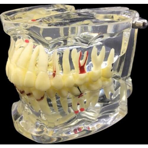 Dental Transparent Adult Pathological Teeth Display Model Disease Teeth Model Dental Lab Equipment Dentist Teaching Model