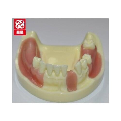 Lack of dental implants model simulation Missing teeth free shipping