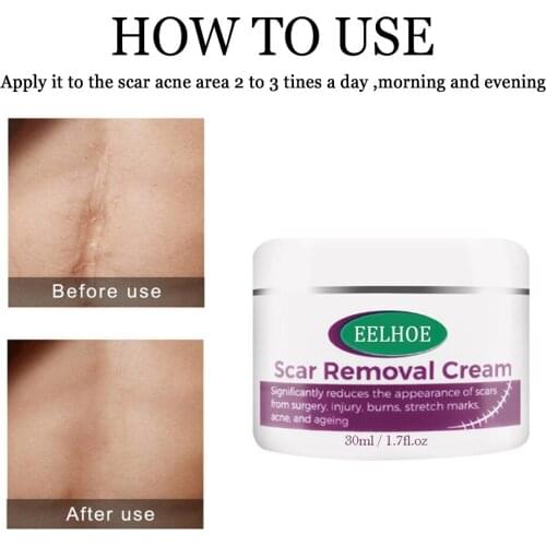30ml Removal Scar Cream Face Pimples Scar Stretch Marks Removal Acne Treatment Whitening Moisturizing Cream Skin Care