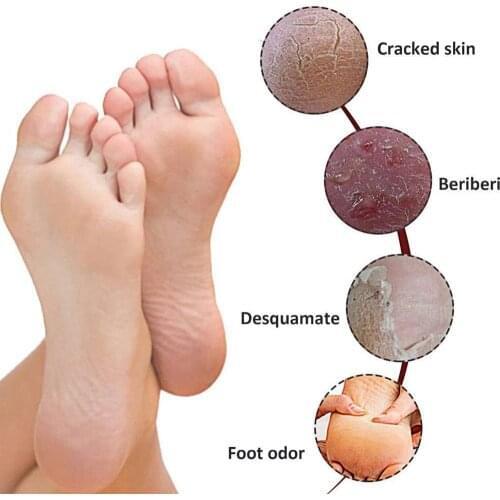 Chinese Medicine Feet Care Smelly Sweaty Useful Itching Mist Foot Odor Itching Treatment Foot Foot Athletes Cream W3W6