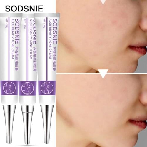 SODSNIE 20g Face Cream-Aloe Vera Gel Anti Acne Moisturizing Facial Damage Repair Spots Cosmetics Face Skin Care TSLM1