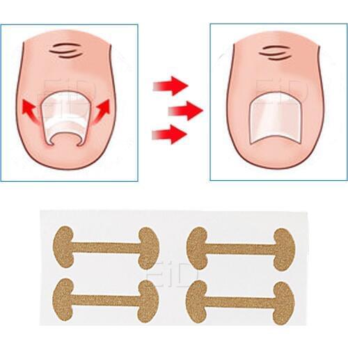 4Pcs Toe Nail Treatment Sticker for Ingrown Toenail Corrector for Paronychia Care Correction Recover Patch Foot Toe Nail Care