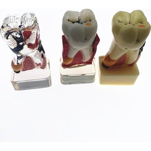 Teeth Model 4 times tooth pathology model Comprehensive Periodontal Model For Teaching Study model