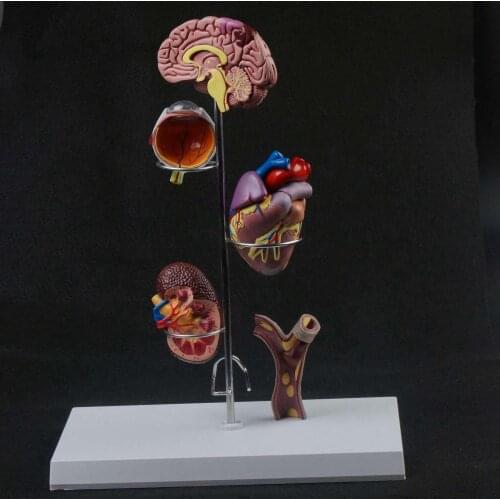 Human Hypertensive Model Cerebrovascular Medicine General Anatomical Surgery