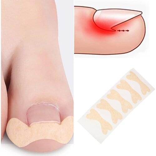 1sheet Ingrown Toe Foot Nail Correction Sticker Pedicure Toenail Corrector New