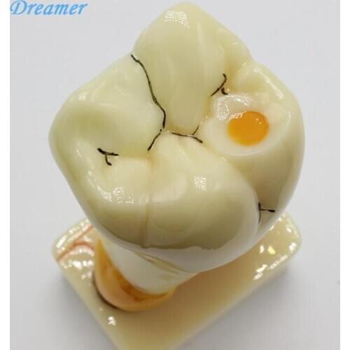 Dental Teeth Common Pathologies Model Anatomy Model Anatomia Tooth Decay Model