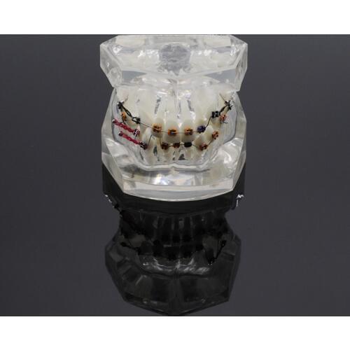 Dentist Lab Tooth Orthodontic Model Malocclusion Models Teaching Model Transparent