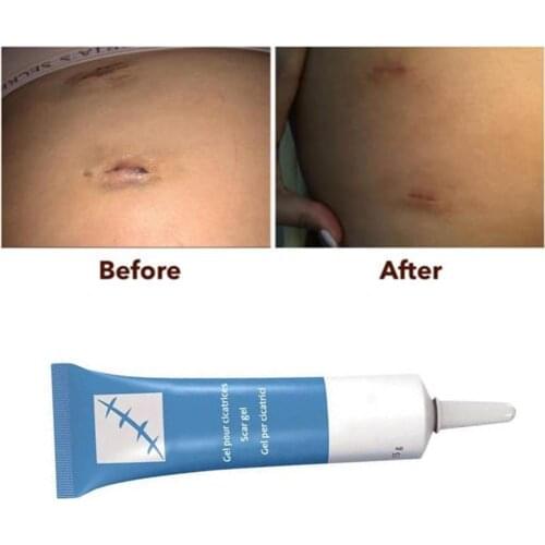 15g Scar Removal Cream Face Cream Acne Scars Gel Stretch Marks Surgical Scar Burn Repair Skin Care Pigmentation Corrector Acne