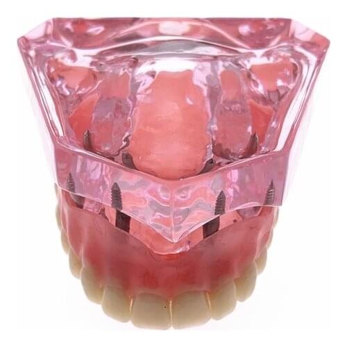 Dental Overdenture Upper Anterior Maxillary with 4 Implants Restoration Teeth Study Teach Model