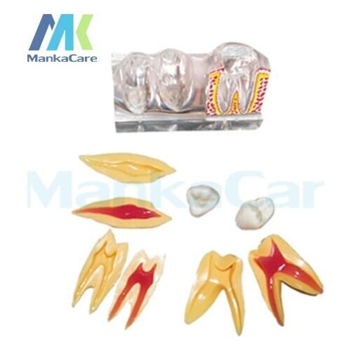 1 set Dental Implant Disease Teeth Model with Restoration Bridge Dentist for Medical Science Teaching 4 times teeth model