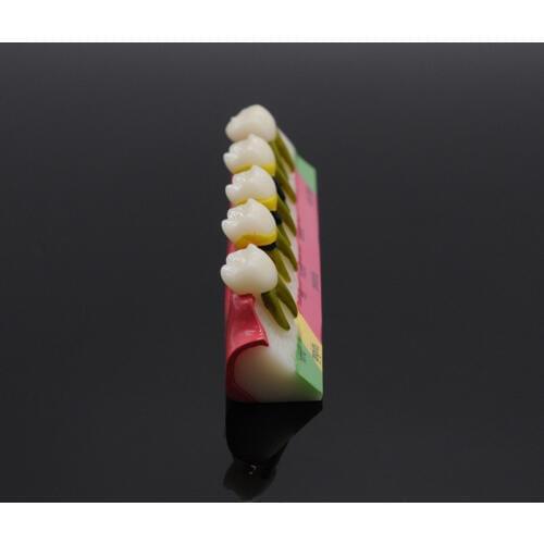 Periodontal Disease Assort Tooth Typodont Model Study Teaching Model For Dental Lab Supplies