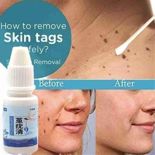 10ml Skin Tag Remover Genital Wart Treatment Papillomas Removal Of Warts Liquid Against Moles Remover Anti Verruca Remedy