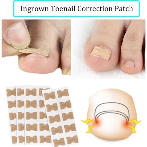 100Pieces Non-glue Correcting Toenail Patch Tape Non-woven Ingrown Toenail Correction Patch Nail Valgus Prevention Sticker