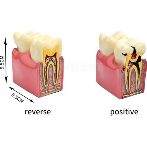 1Pcs Denture Caries Comparison Model Tooth Decay Model Dentist Pathologies For Medical Science Teaching