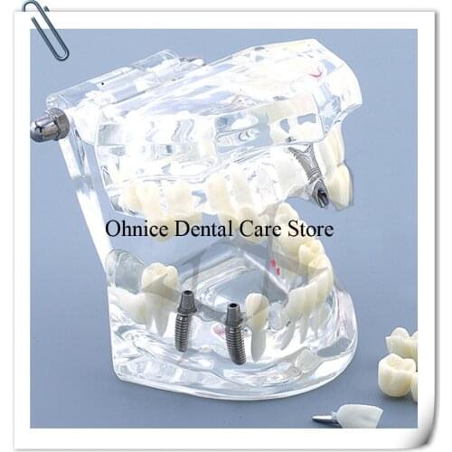 Dental teaching tooth model M2001/Dental Lab Clinic teeth model shows Implant Restoration/Dental Implant model