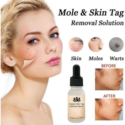 Newstly Mighty Tag & Spots Remover Serum Painless Mole Skin Freckle Removal Cream Wart Face Tag Dark Tag Skin Removal Spot N8U1