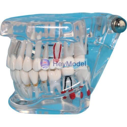 HeyModel Transparent Teeth Repair Model Real Size 1:1