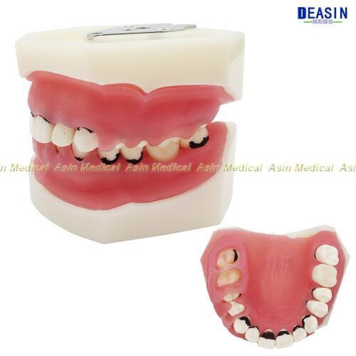 Deasin new Dental Periodontal Disease Model / Tooth Medical Model dentist learning model