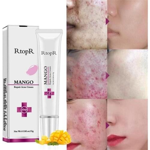 RtopR 30g Mango Acne Cream Effective Remove Acne Scar Face Care Restore Smooth Skin Invisible Pores Cream Removal Gel Acne TSLM1