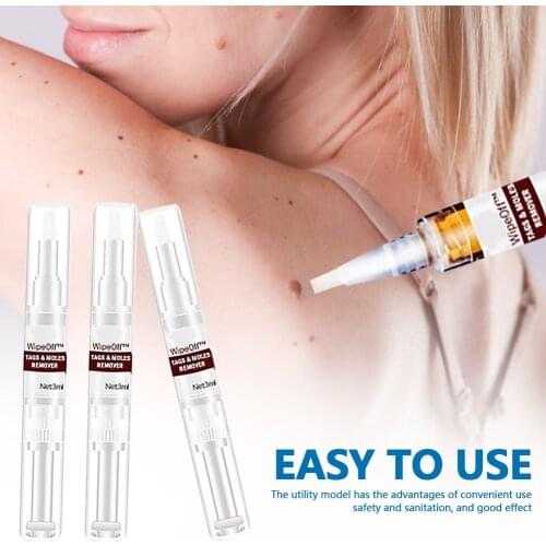 Genital Wart Treatment Papillomas Removal Of Warts Liquid From Skin Tags Removing Against Moles Remover Anti Verruca Remedy