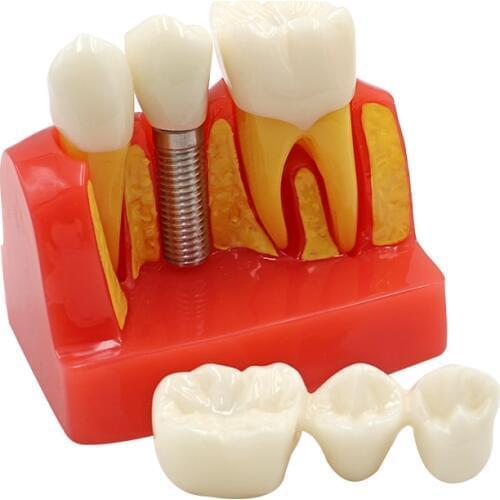 1pc Dental Implant Teeth Model 4/Four Times Dental Resin Quartz Rubber Teeth Model Dentist Teaching Training Pathology Model