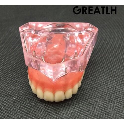 Dental Overdenture Superior with 4 Implants Demo Model Dental Teaching Study Demonstrate Model #6001 01