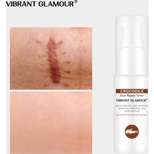 2021 Efficient repair Crocodile Scar Skin Repair Water Spot Repair Acne Treatment Remove Blackhead Stretch Marks Skin Cream