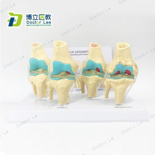 Human Knee Joint Model 4-stage Knee Joint Disease Model Anatomical Model